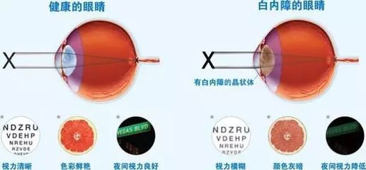 同仁眼科专家王怀洲:青光眼手术后视力下降,原因可能是这些
